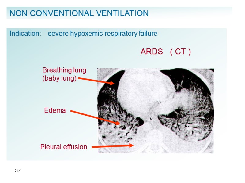 37 NON CONVENTIONAL VENTILATION Indication:    severe hypoxemic respiratory failure  